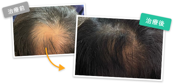 AGA鍼治療のbefore after